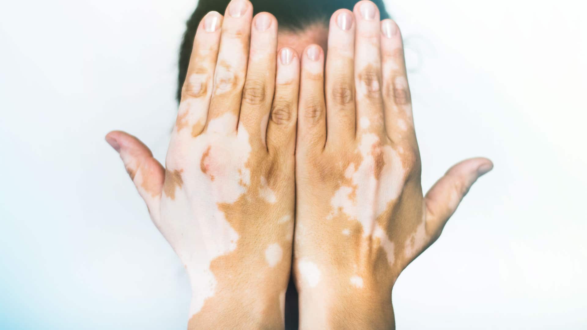 vitiligo si vitamina D