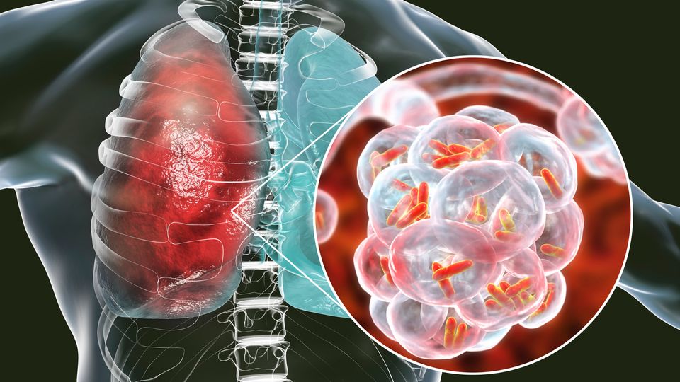 reperezenatre grafica a plamanilor bolnavi de pneumonie