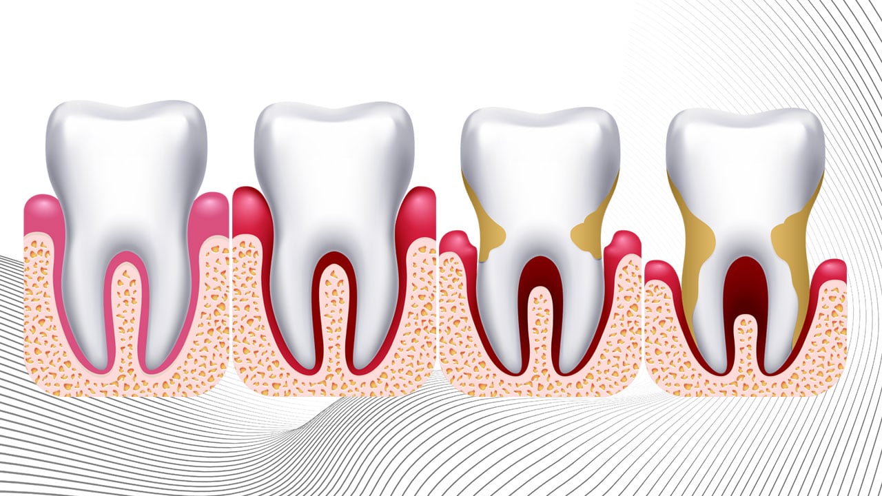 reprezentarea gingivitei