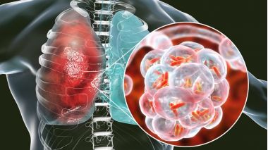 reperezenatre grafica a plamanilor bolnavi de pneumonie