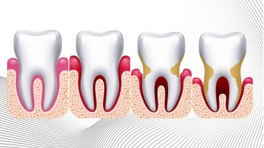 reprezentarea gingivitei