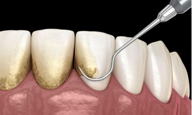 reprezentare a tartrului dentar