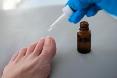 n medic în mănuși medicale picură ulei de arbore de ceai dintr-o pipetă pe un deget inflamat